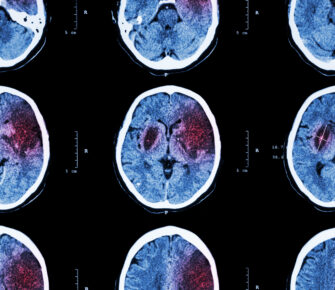 Stroke Awareness Month: Do kids get strokes?