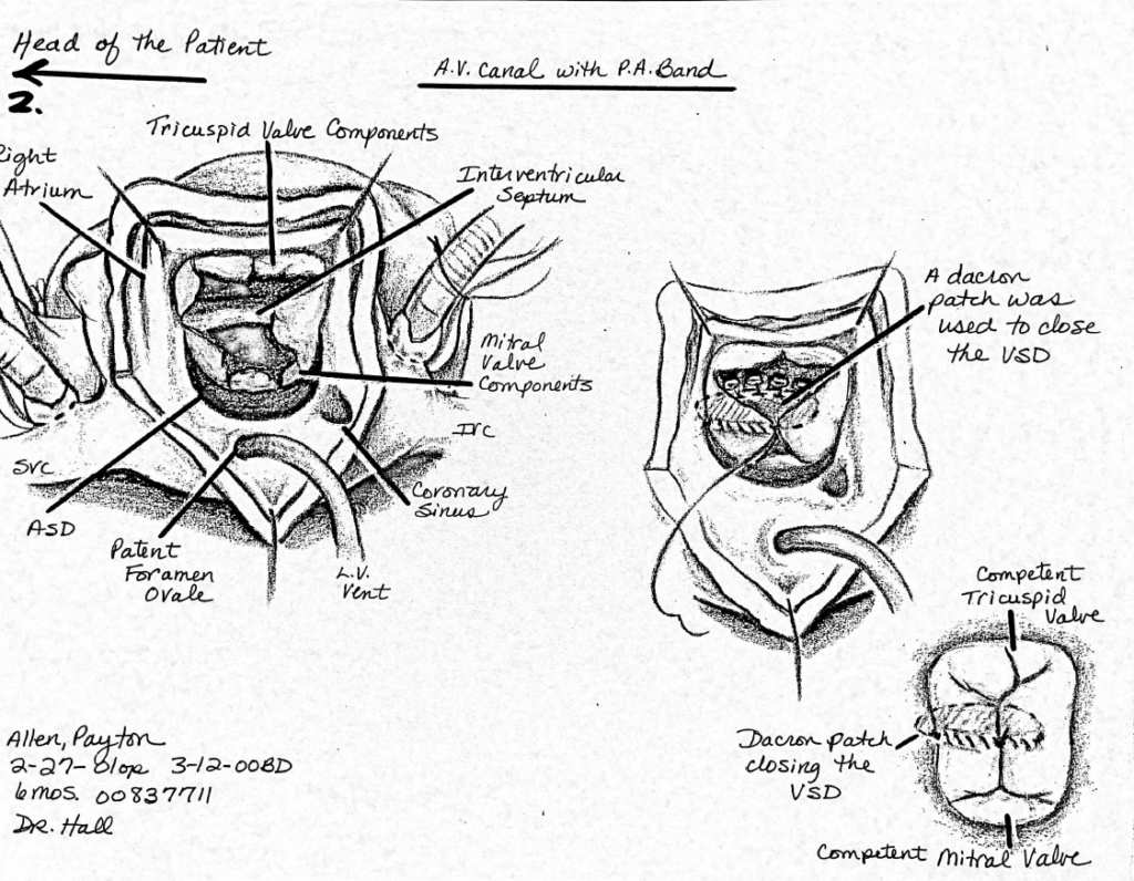 A medical illustration by Susie Russell Hall of one of Payton’s cardiac surgeries at 6 months old.